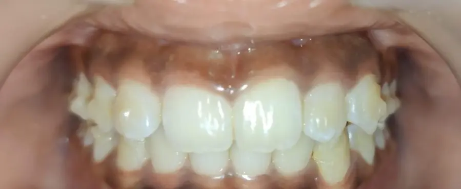 After Invisalign treatment showing straight aligned teeth and improved smile