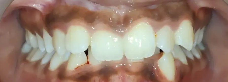 Before Invisalign treatment showing misaligned teeth and crowding